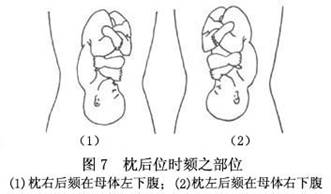 持续性枕后位图片