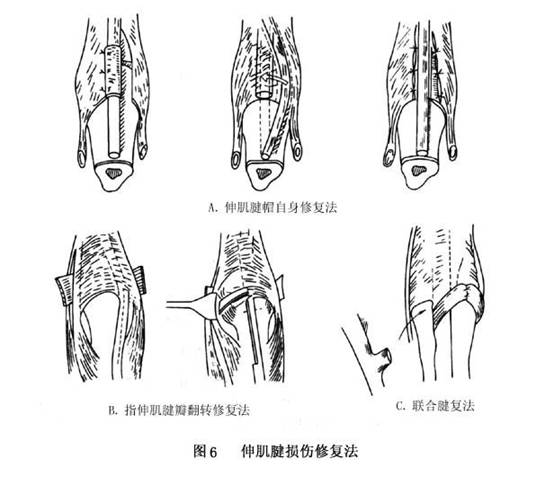 手部伸肌腱损伤概述 病因 诊断 治疗 预防 微医 挂号网