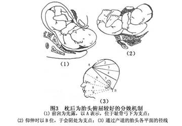 左枕后位可以顺产吗图片