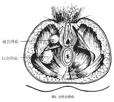 会阴疝详情页,会阴疝哪家医院看得好