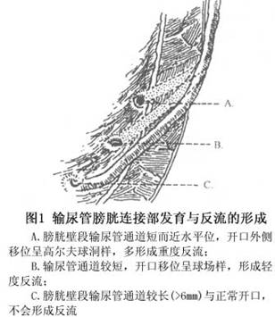 解剖生理特點 輸尿管膀胱連接部解剖生理特點與反流的形成有密切關係