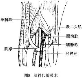 原发性下肢静脉机能不全