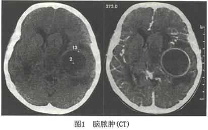脑脓肿MRI图片