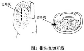 化脓性指头炎