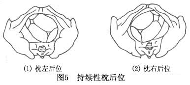 持续性枕后位难产概述