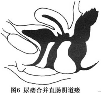 尿道阴道瘘孔径 1cm