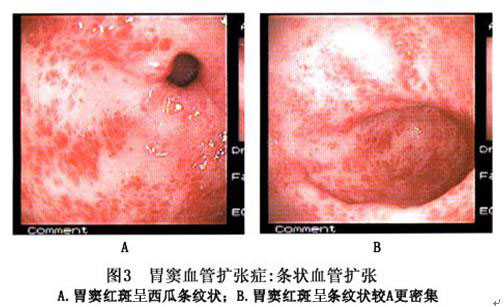 西瓜胃詳情頁,西瓜胃哪家醫院看得好|治療西瓜胃哪個醫生好|西瓜胃推