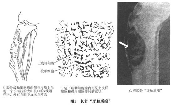 长骨造釉细胞瘤图片