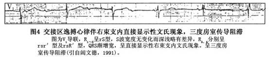 右束支传导阻滞