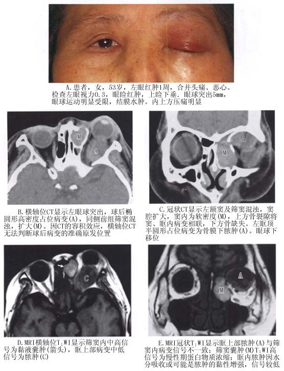 眼眶脓肿图片