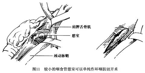 环咽肌 解剖图图片