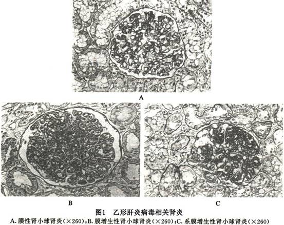 乙型肝炎 肾炎概述 病因 诊断 治疗 预防 微医 挂号网