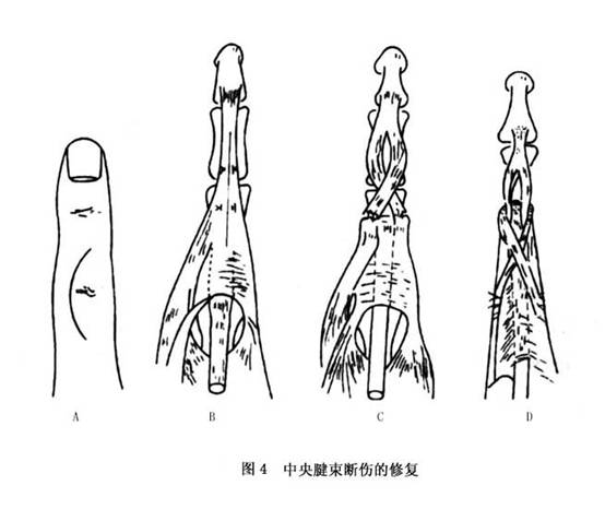 手部伸肌腱损伤概述 病因 诊断 治疗 预防 微医 挂号网