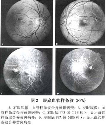 眼底新生血管图片